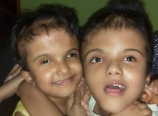 Újabb műtétet végeztek a szétválasztott bangladesi ikerlányok egyikén