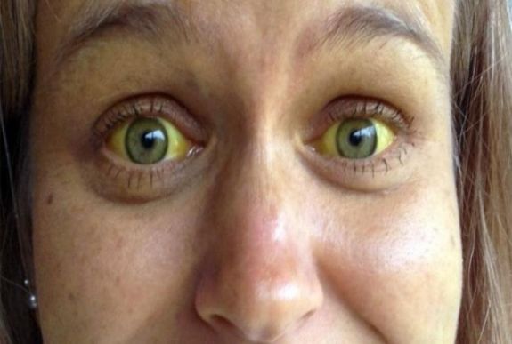 A típusú hepatitisz-gócot azonosítottak a Fehér megyei Felvincen