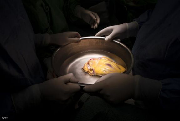 Ugyanattól a szervdonortól lett rákos négy transzplantált beteg