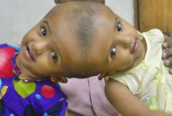 Stabil állapotban van a szétválasztott sziámi ikrek mindkét tagja 