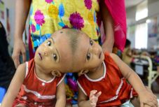 Rekonstrukciós műtéten estek át a szétválasztott sziámi ikrek