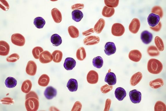 Magyar kutatócsoport eredményei tehetik hatékonyabbá a leukémia kezelését