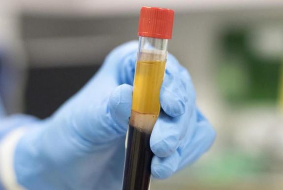 A vérplazmakezelés is hatásos lehet koronavírus ellen