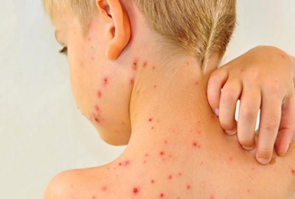 68 kanyarós megbetegedést diagnosztizáltak Romániában az elmúlt héten